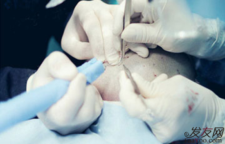 植發(fā)手術(shù)中會有危害嗎,如何避免植發(fā)的危害發(fā)生