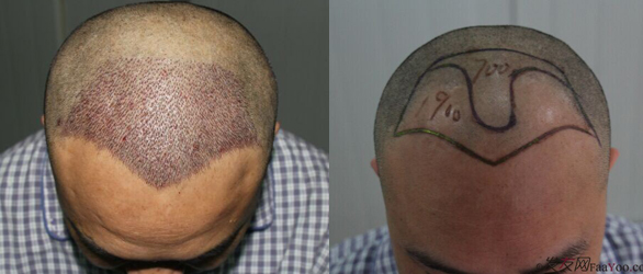 抗戰(zhàn)勝利日植發(fā)的發(fā)友提前領(lǐng)取“植發(fā)優(yōu)惠券 