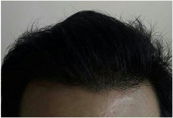 植發(fā)8個多月，效果我很滿意！ 發(fā)友案例　