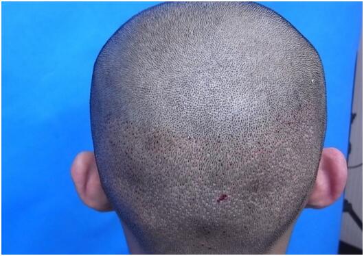 前額植發(fā)效果分享　