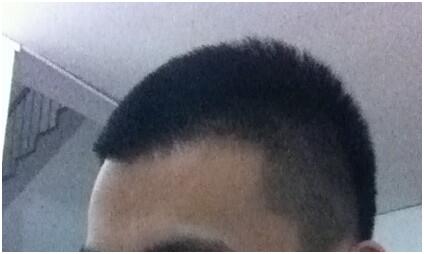 前額植發(fā)效果分享　