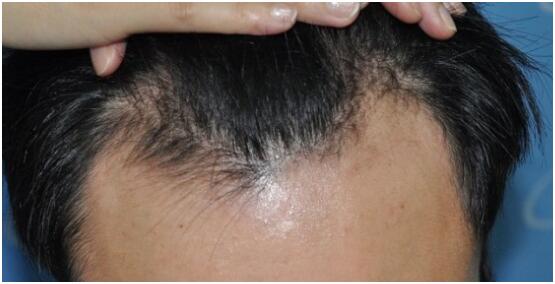 天生前額高植發(fā)的效果怎么樣？　