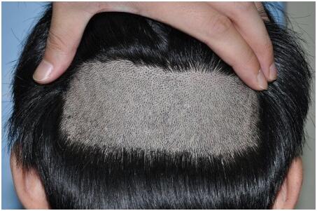 天生前額高植發(fā)的效果怎么樣？　