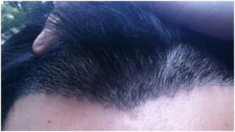 天生前額高植發(fā)的效果怎么樣？　