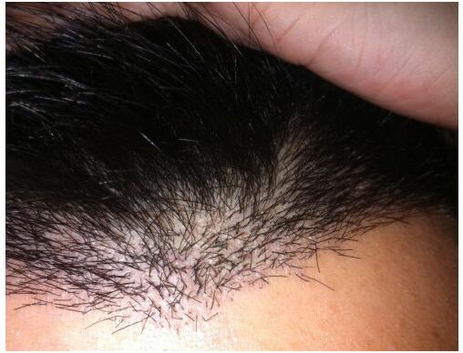 天生前額高植發(fā)的效果怎么樣？　