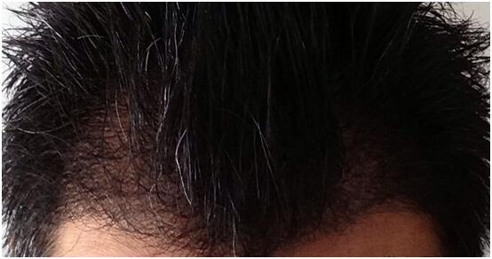 [前額植發(fā)] 植發(fā)2500單位　