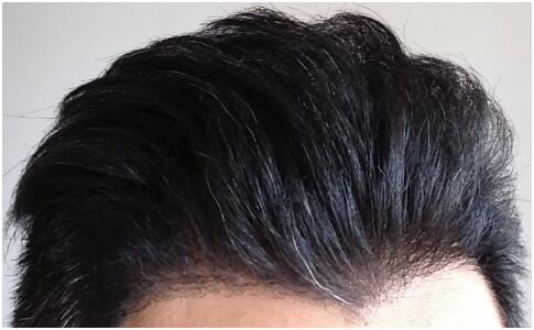 [前額植發(fā)] 植發(fā)2500單位　