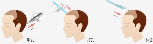 植發(fā)到底有沒有危害呢？　