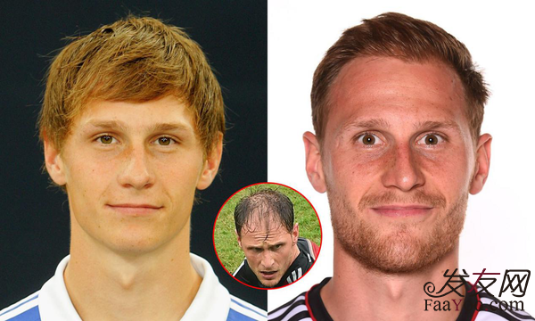 赫韋德斯植發(fā)