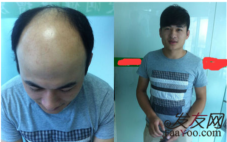 植發(fā)手術(shù)需要花多少錢