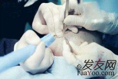 植發(fā)價(jià)格是怎么判斷的？