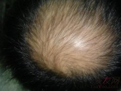 植發(fā)價(jià)格真的貴到讓人望而卻步嗎？