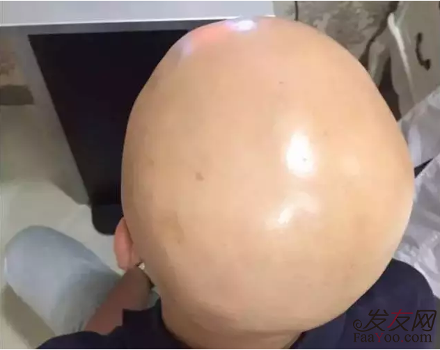 生活中防脫發(fā)有哪些好方法？