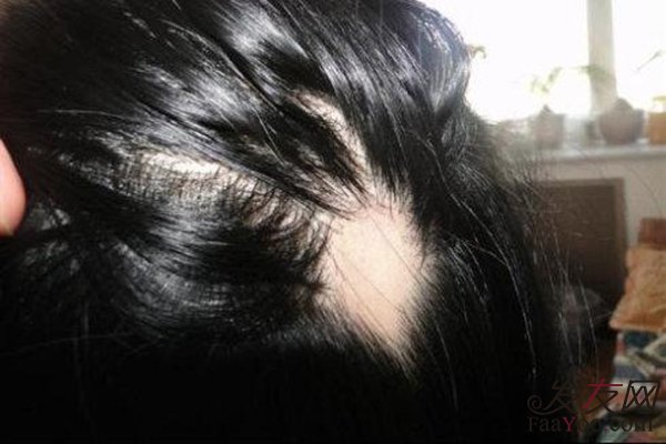 斑禿一般是什么原因引起的？