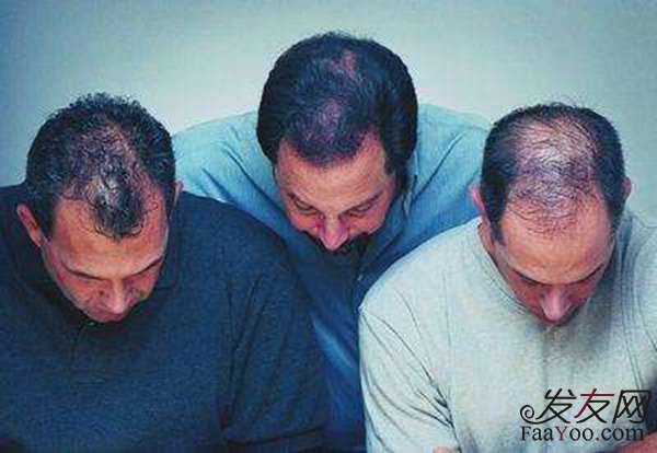 性格也會(huì)影響到頭發(fā)，哪種性格人更易脫發(fā)