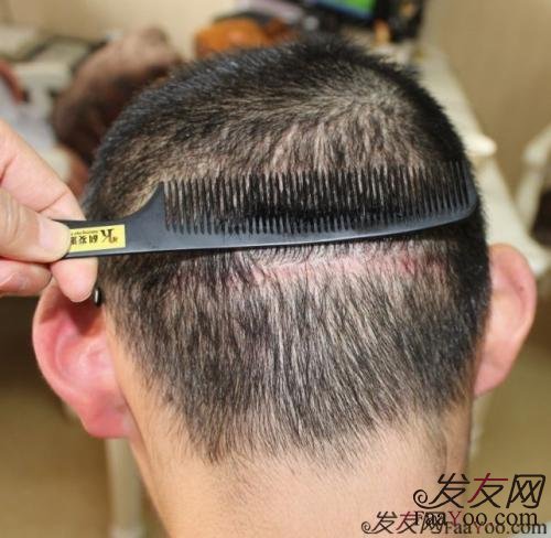 植發(fā)價(jià)格多少錢(qián)算合理？