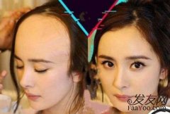 前額植發(fā)一般多少錢？