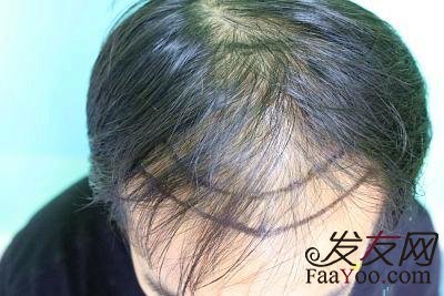  前額植發(fā)一般多少錢？