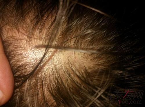  腎虛性脫發(fā)能自愈嗎？