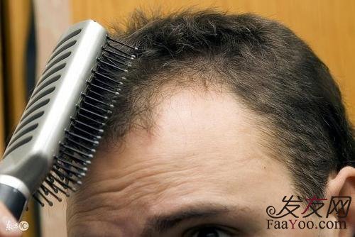  腎虛性脫發(fā)能自愈嗎？