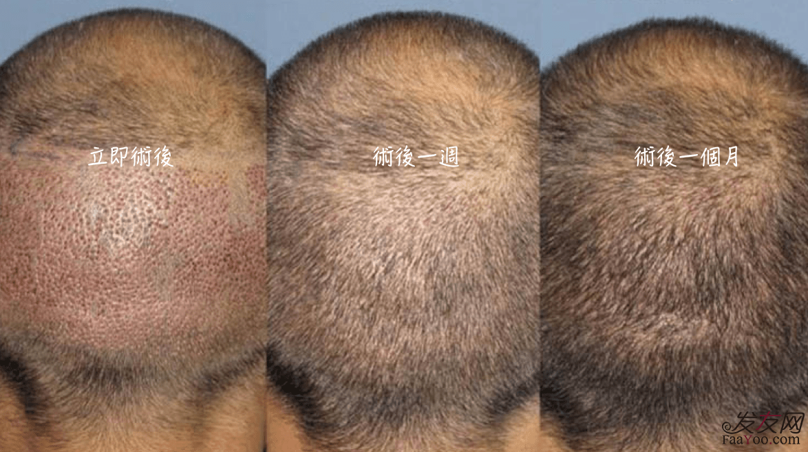 植發(fā)價(jià)格都是怎么定的？