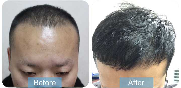 我的植發(fā)日記，來交作業(yè)了！