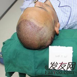 杭州專業(yè)植發(fā)有哪些醫(yī)院