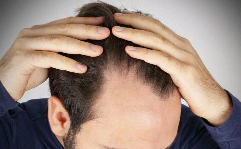 米諾地爾用了三個(gè)月頭頂沒(méi)變密