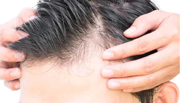 米諾地爾6個月見效