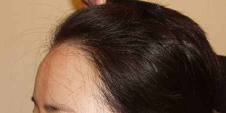 小面積植發(fā)要多少錢