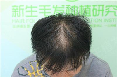 杭州植發(fā)貴嗎，有哪些效果好的醫(yī)院推薦？