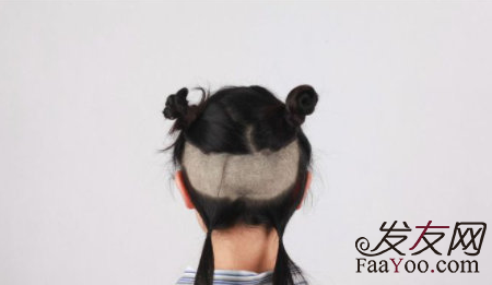 植發(fā)手術(shù)其實(shí)是“拆東墻補(bǔ)西墻”？植發(fā)誤區(qū)！