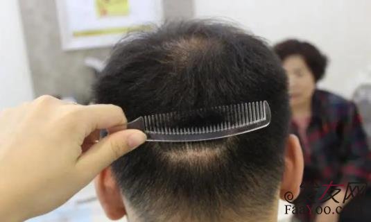 目前市場常見的植發(fā)技術有哪些？不剃發(fā)技術怎么樣？