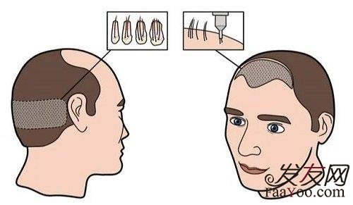 關于遺傳性的脫發(fā)植發(fā)真的有用嗎？必須要用后枕部的毛囊嗎？