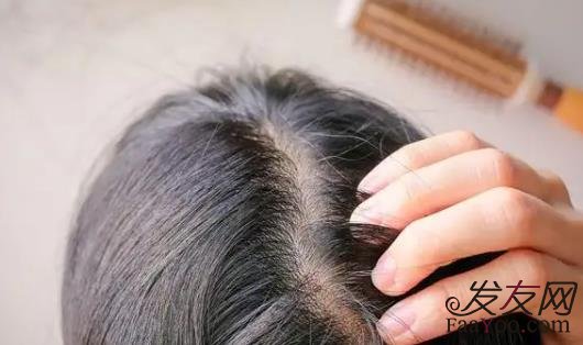 頭發(fā)越來越細(xì)軟怎么辦？植發(fā)可以恢復(fù)嗎？