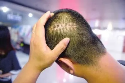 重慶植發(fā)多少錢一個毛囊單位