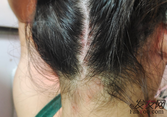 植發(fā)后出現(xiàn)毛囊炎是怎么回事？該如何避免？