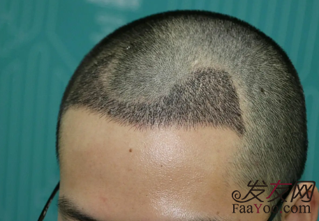 植發(fā)后的脫落期會持續(xù)多久？掉的頭發(fā)還能長出來嗎？