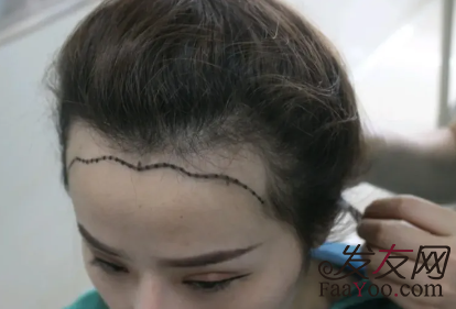 植發(fā)原理：后枕部的頭發(fā)經(jīng)過移植后可以正常生長嗎？