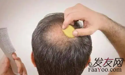 怎么判斷脫發(fā)患者是否適合植發(fā)？需要滿足哪些條件？