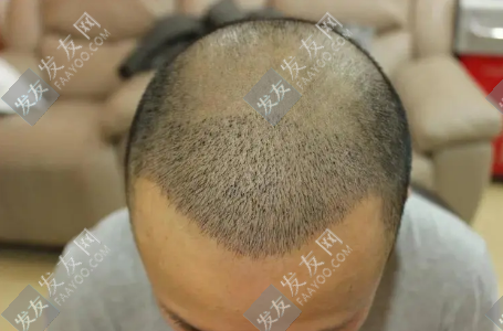 大面積脫發(fā)能植發(fā)嗎？效果可以保持多長時間？