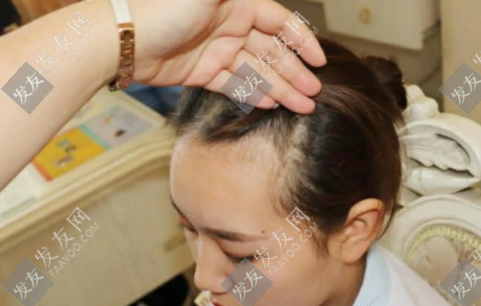 植發(fā)后頭發(fā)掉的更厲害是怎么回事？是手術(shù)失敗了嗎？