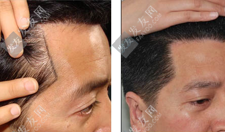 植發(fā)后多久頭發(fā)可以長出來？還需要用藥嗎？