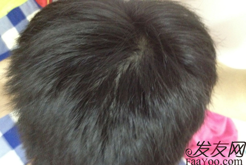預(yù)防脫發(fā)，防止病理性脫發(fā)發(fā)生，文章圖片1