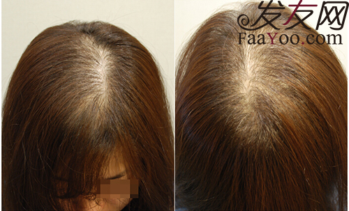 患上腎虛型脫發(fā)不僅僅有男性,女性也會患上此脫發(fā)