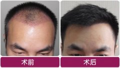 植發(fā)價(jià)格看什么？影響植發(fā)價(jià)格的因素