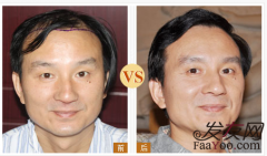 植發(fā)手術(shù)價(jià)格怎么判斷多少