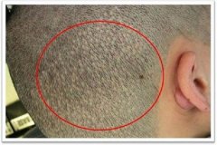 關于fue你真的知道嗎？fue貴嗎？