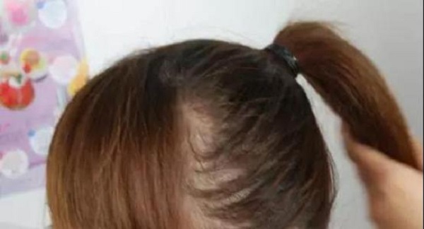 常見(jiàn)脫發(fā)類(lèi)型有哪幾種