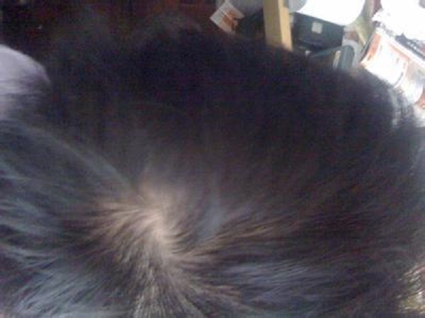 常見(jiàn)脫發(fā)類(lèi)型有哪幾種